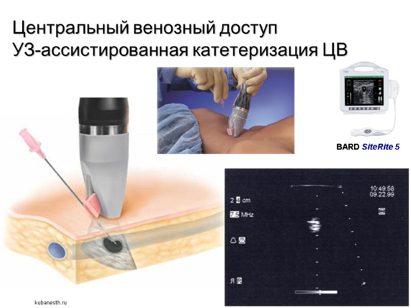 Центральный венозный доступ УЗ-ассистированная катетеризация ЦВ BARD SiteRite 5